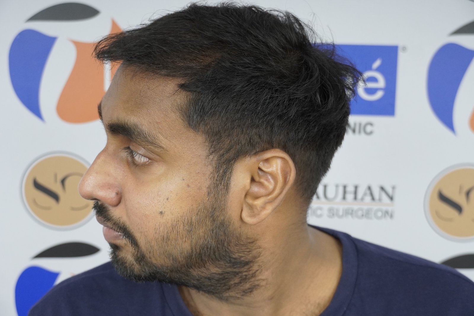 Shreyankar Maurya After Hair Transplant